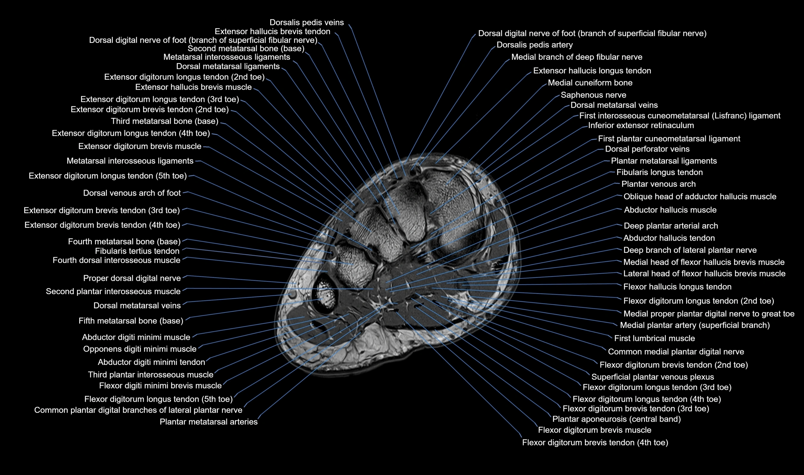 MRI mid foot axial cross sectional anatomy 3T  radiology  image-img-00001-00015.webp